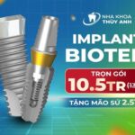 Top 3 dòng trụ Implant được sử dụng nhiều nhất 