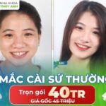 Nên chọn niềng răng mắc cài sứ thường hay niềng răng Invisalign?