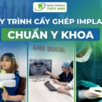 Cấy Implant có an toàn không? Quy trình cấy ghép răng implant