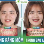 Thời gian niềng răng móm trong bao lâu?