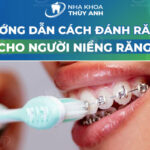 Cách đánh răng khi niềng răng - Làm thế nào cho đúng?