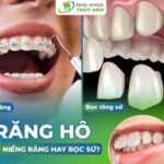 Răng hô nên niềng răng hay bọc sứ?