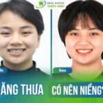 Răng thưa có nên niềng? Giải pháp cho răng bị thưa?